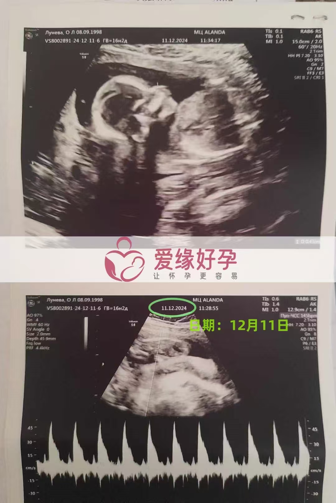 哈萨克斯坦代孕代母孕17周产检顺利通过
