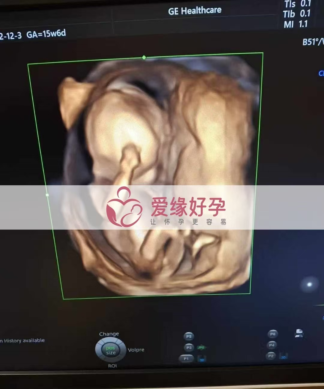 乌克兰代孕代母孕15周产检顺利通过