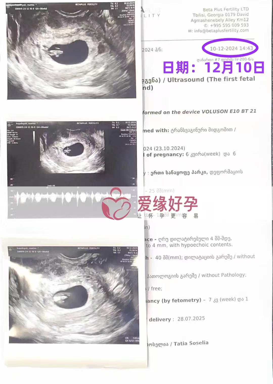 格鲁吉亚代孕代母孕7周产检顺利通过