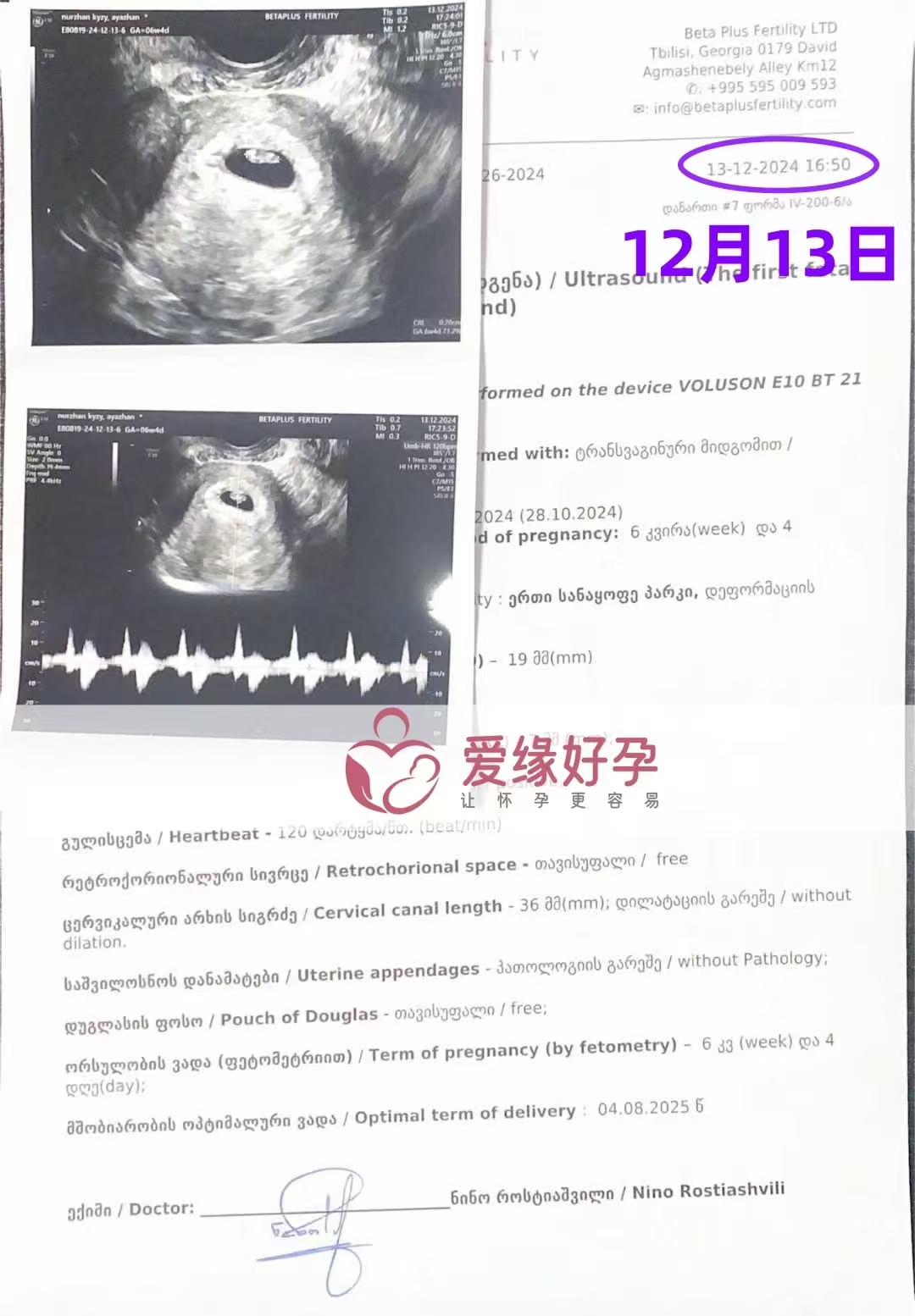 格鲁吉亚代孕代母孕6周产检顺利通过