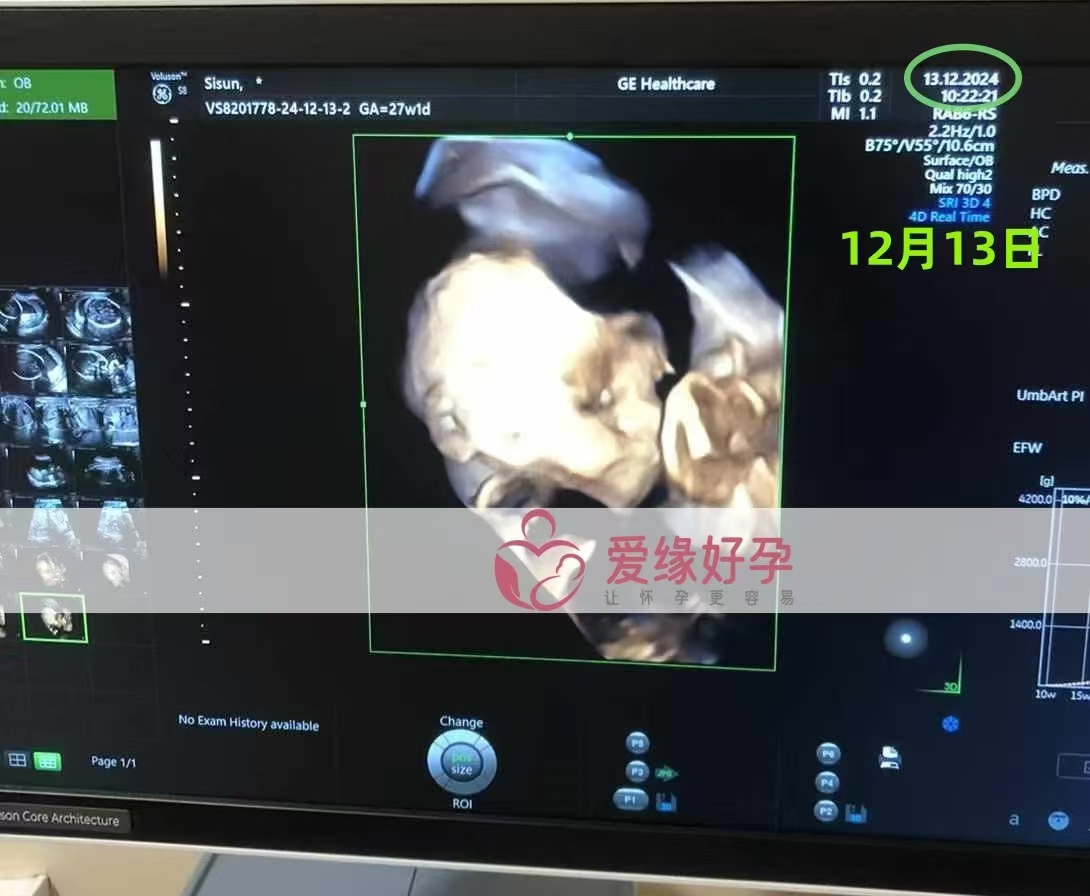 乌克兰代孕代母孕26周大排畸产检顺利通过