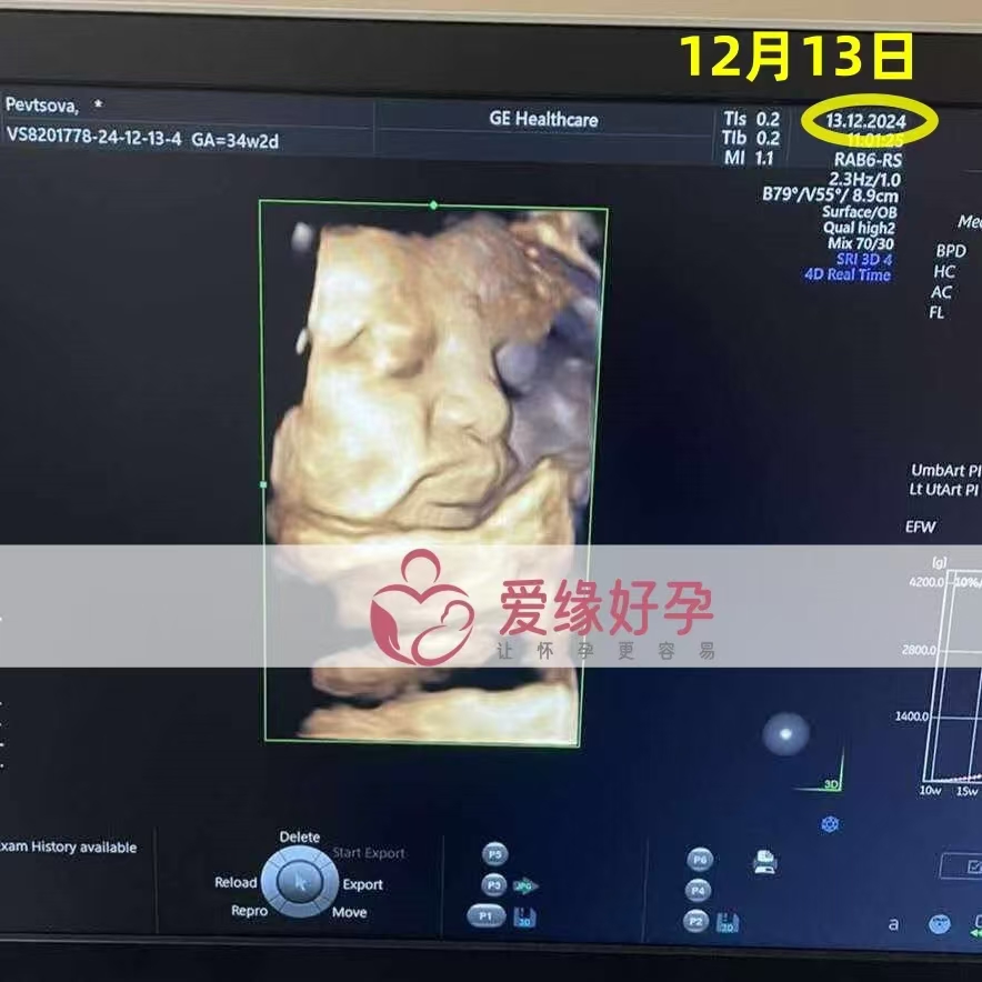 乌克兰代孕代母孕34周产检顺利通过