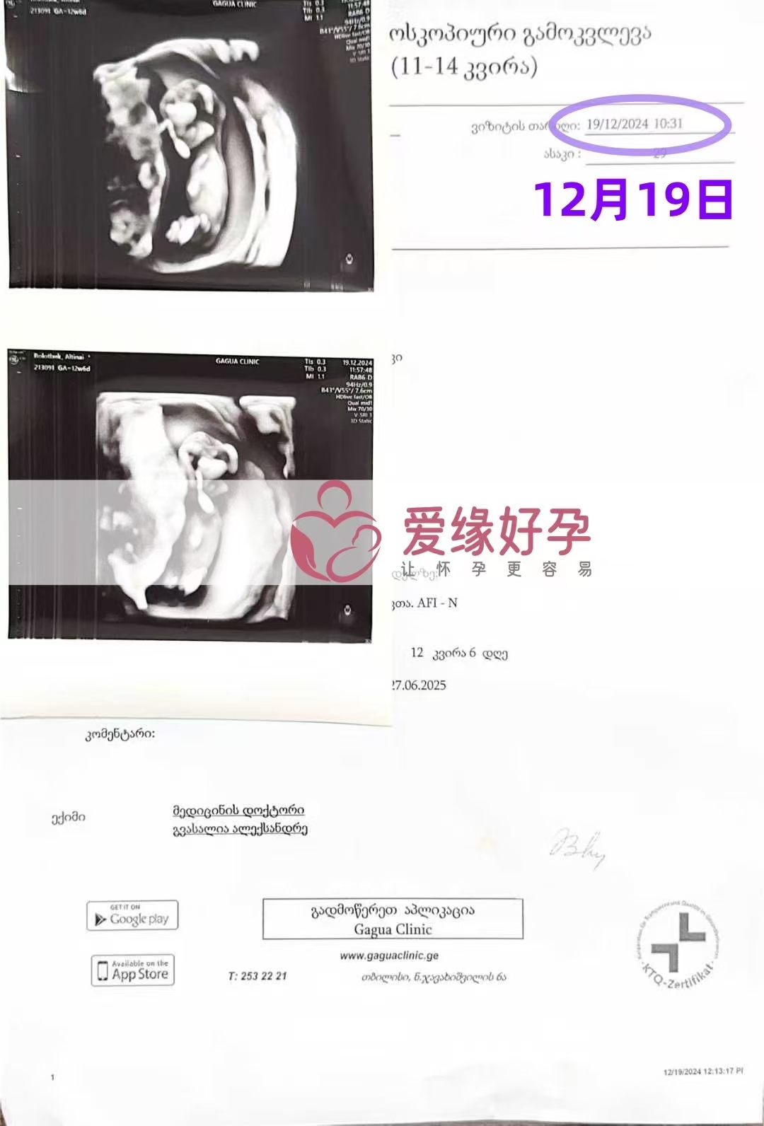 格鲁吉亚代孕代母孕12周产检顺利通过