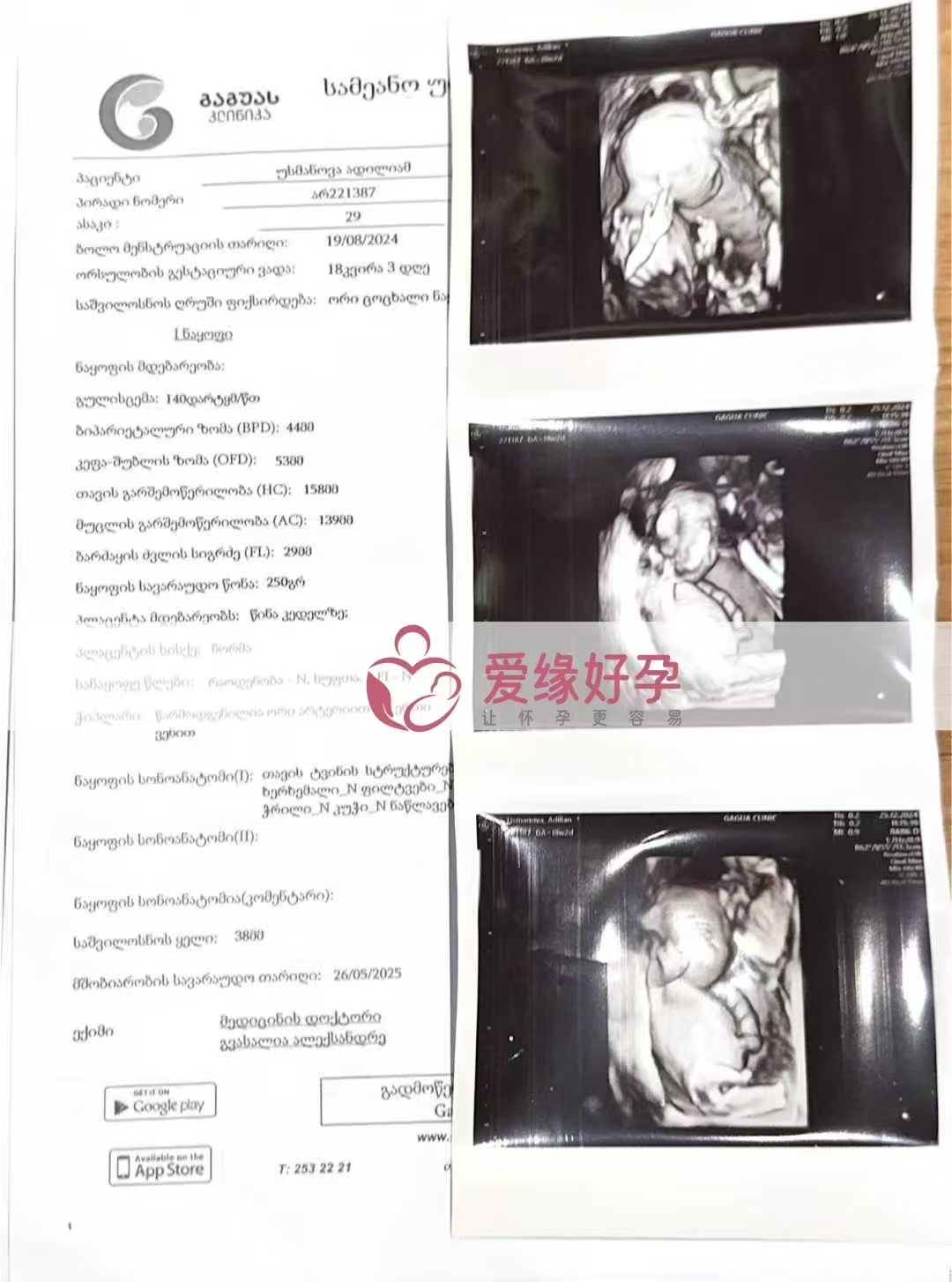 格鲁吉亚代孕代母孕18周产检顺利通过