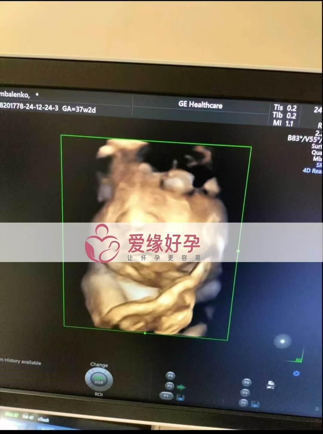 乌克兰代孕代母孕37周产检顺利通过