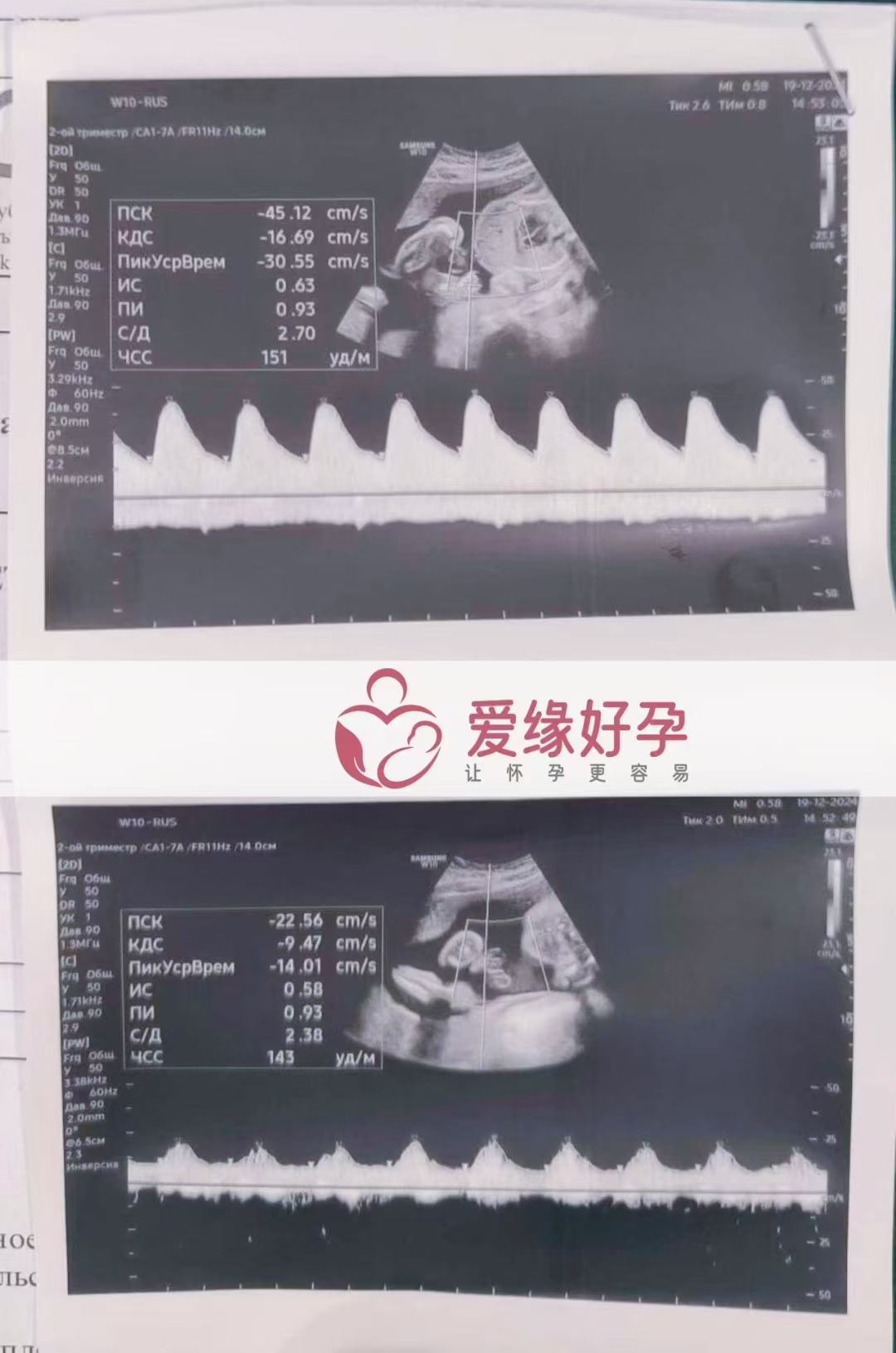 哈萨克斯坦代孕代母孕25周产检顺利通过
