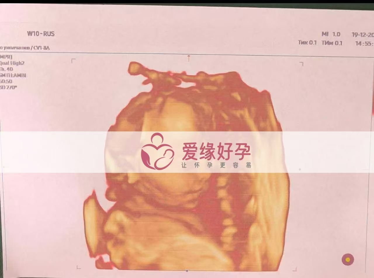 哈萨克斯坦代孕代母孕25周产检顺利通过
