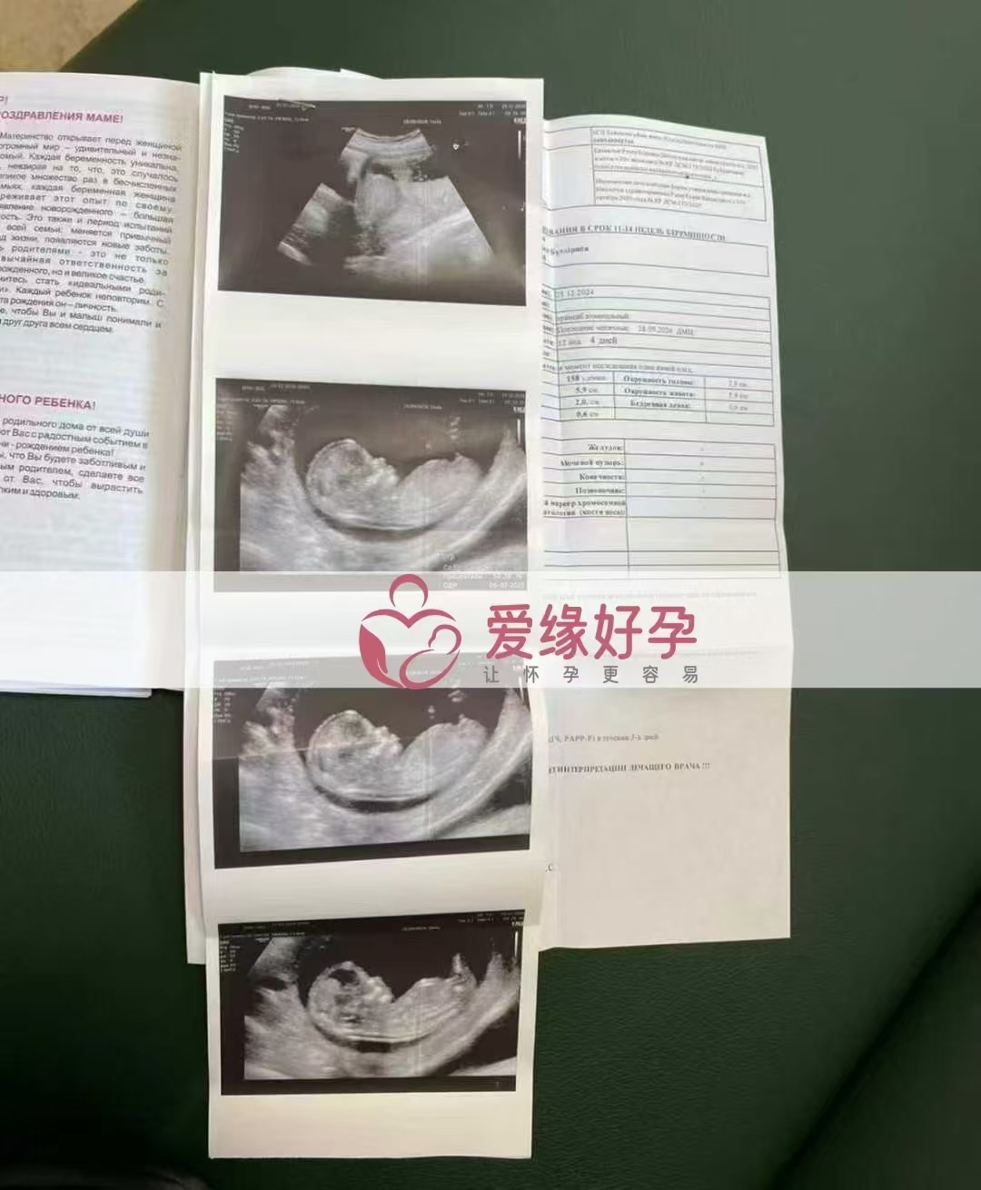 哈萨克斯坦代孕代母孕12周NT产检顺利通过