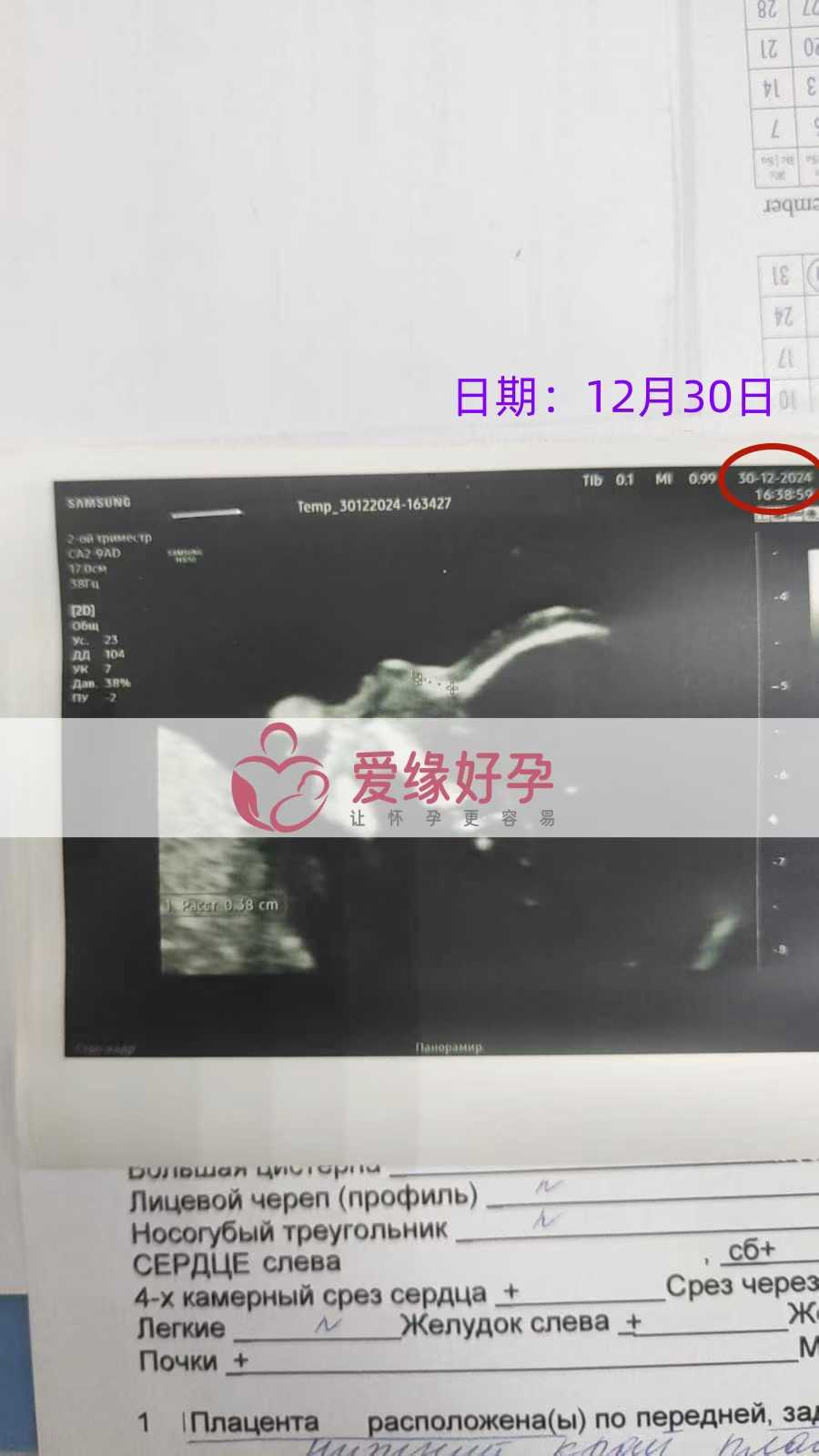 格鲁吉亚代孕代母孕16周产检顺利通过