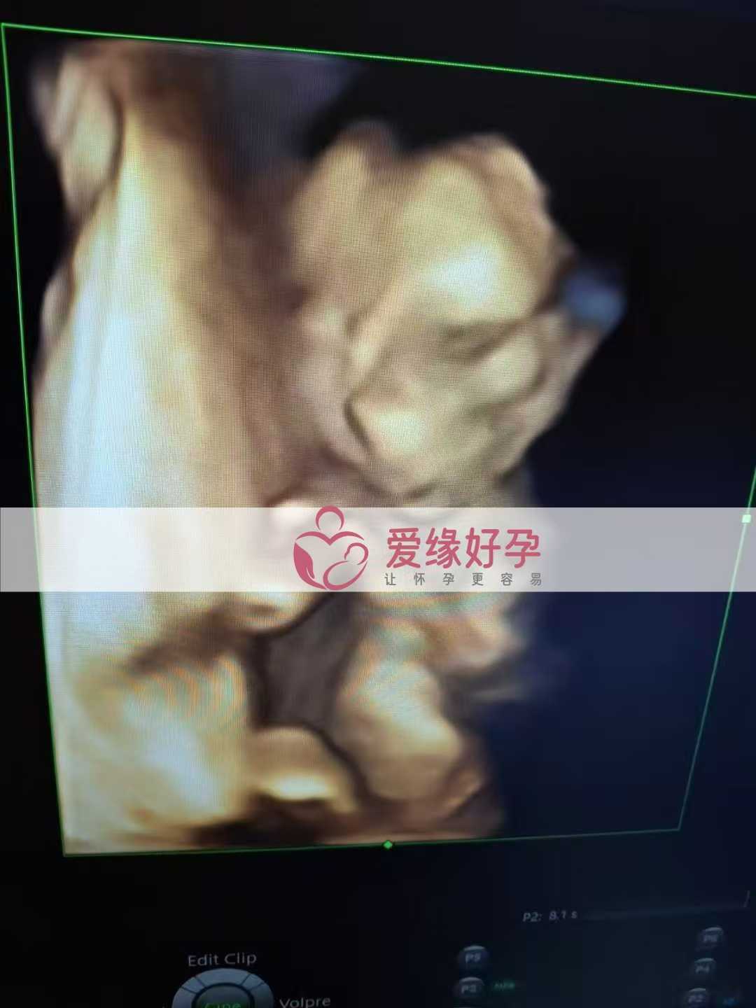乌克兰代孕代母孕38周产检顺利通过