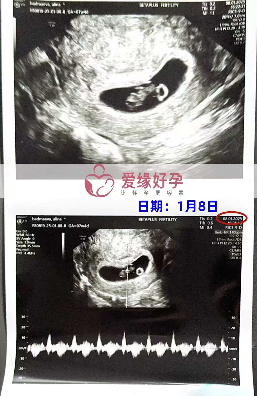 格鲁吉亚代孕代母孕7周产检顺利通过