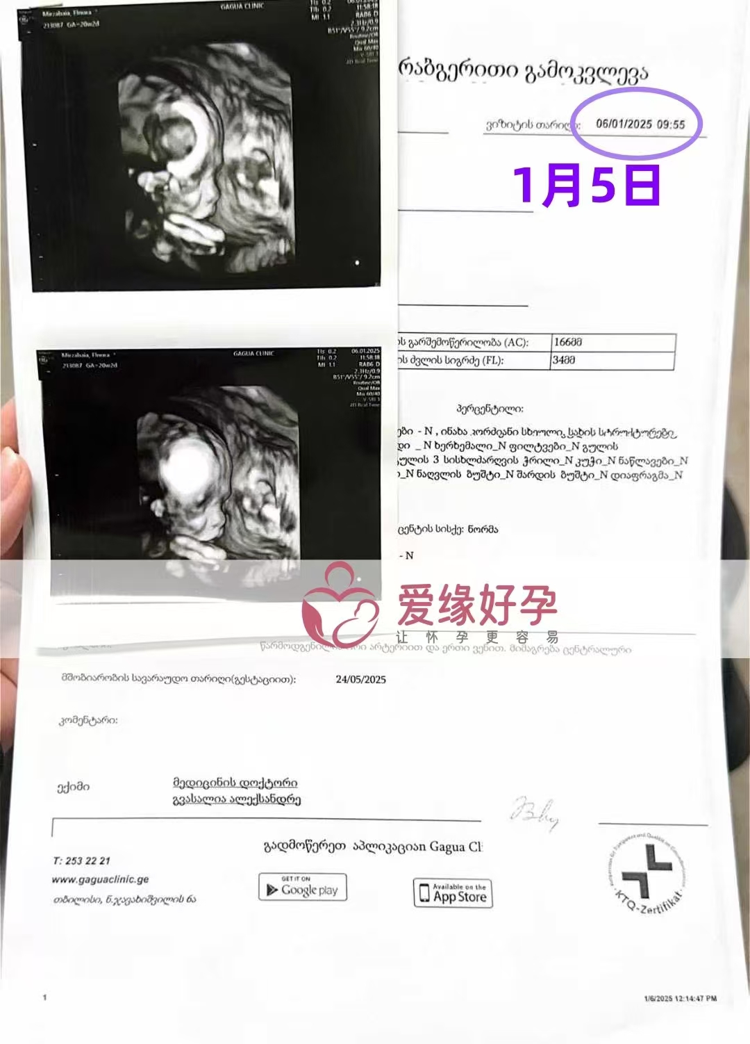 格鲁吉亚代孕代母孕20周产检顺利通过