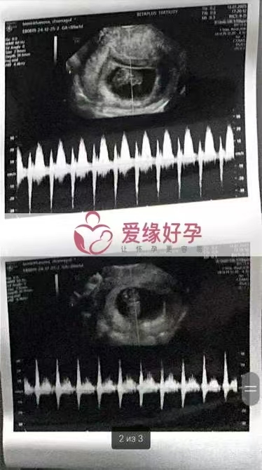 格鲁吉亚代孕代母双胞胎孕9周产检顺利通过