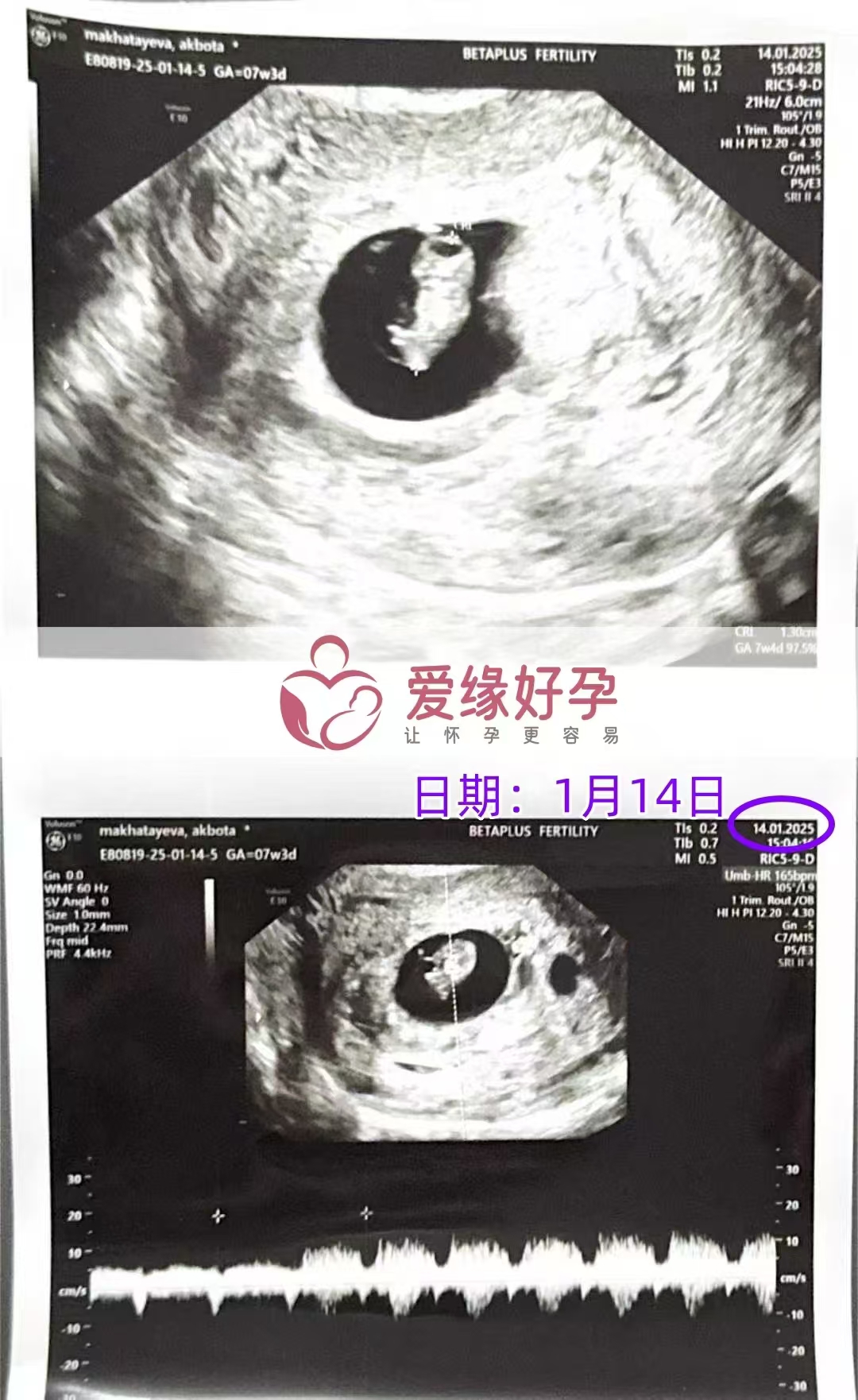 格鲁吉亚代孕代母孕7周产检顺利通过