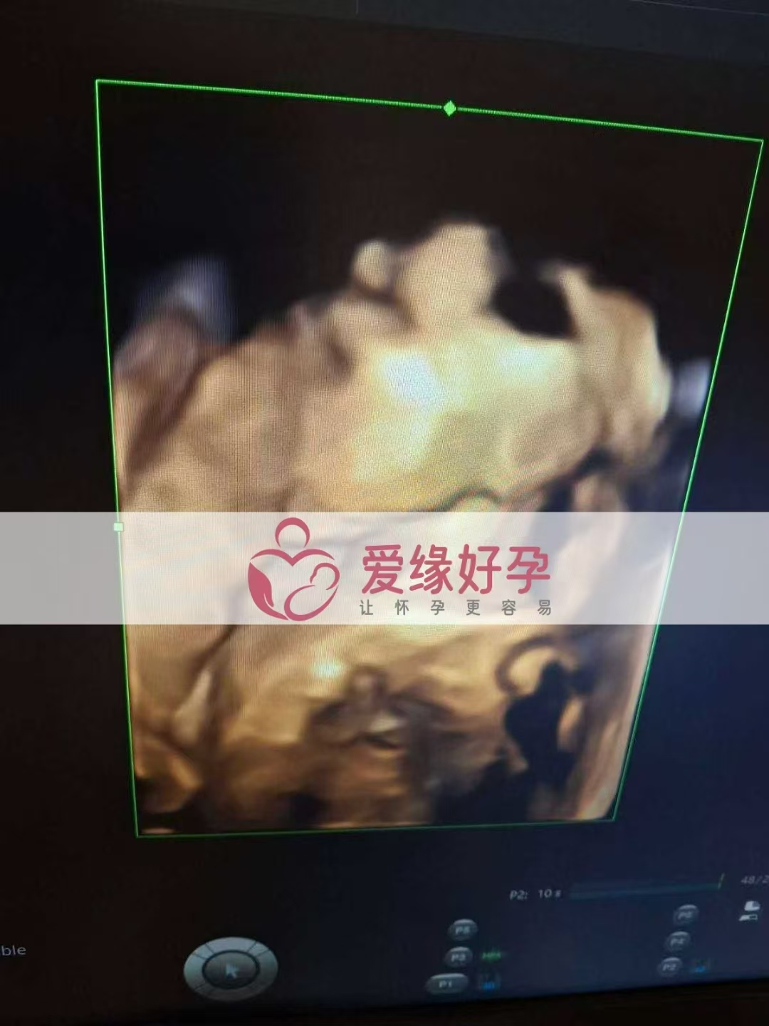 乌克兰代孕代母孕24周产检顺利通过