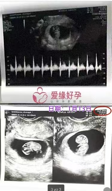 格鲁吉亚代孕代母双胞胎孕9周产检顺利通过