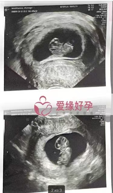 格鲁吉亚代孕代母双胞胎孕9周产检顺利通过