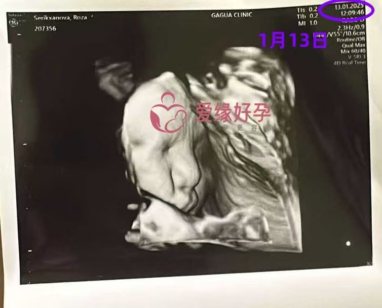 格鲁吉亚代孕代母孕37周产检顺利通过