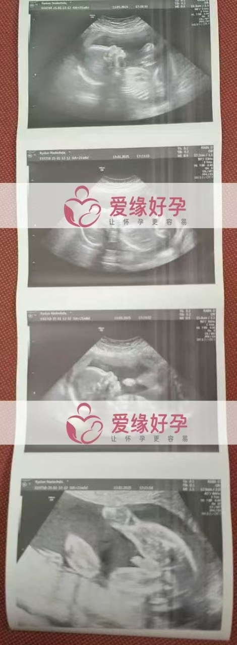格鲁吉亚代孕代母孕21周产检顺利通过