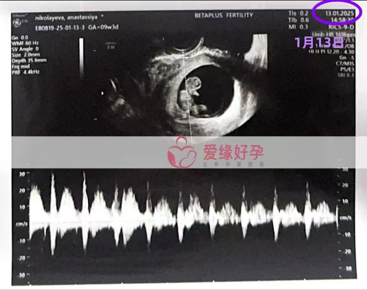 格鲁吉亚代孕代母孕9周产检顺利通过