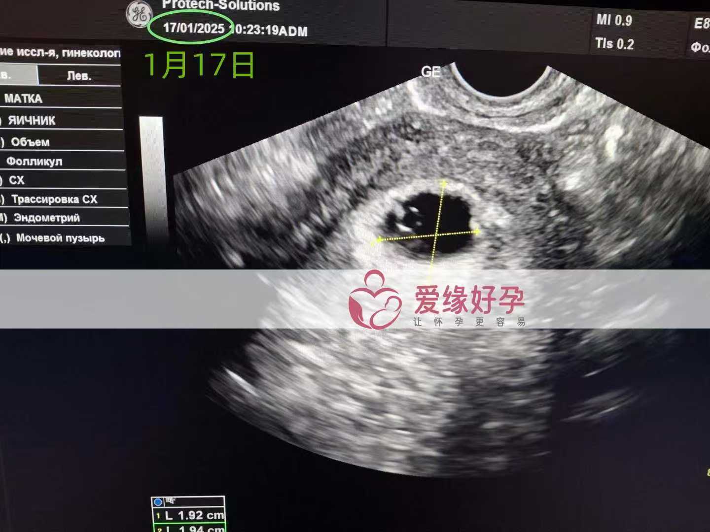 格鲁吉亚代孕代母孕5周产检顺利通过