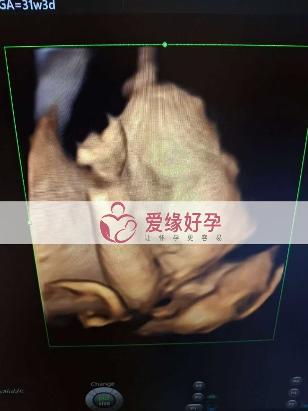 乌克兰代孕代母孕31周产检顺利通过