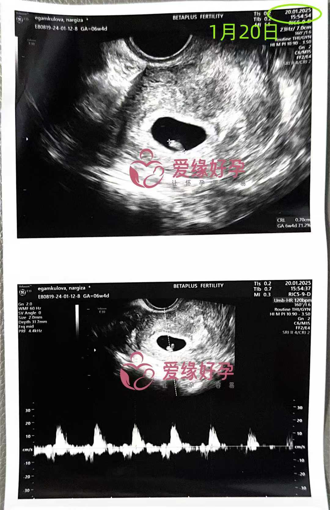 格鲁吉亚代孕代母第一次B超产检顺利通过