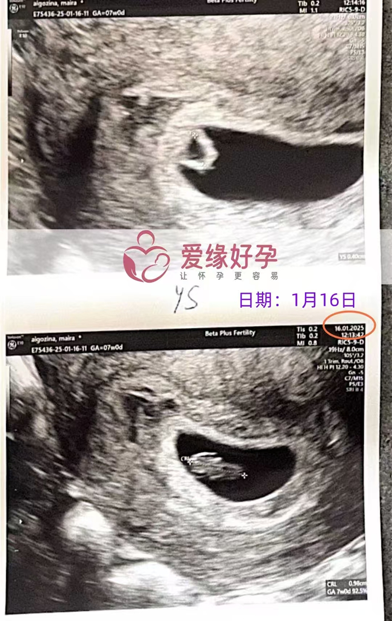 格鲁吉亚代孕代母孕7周产检顺利通过