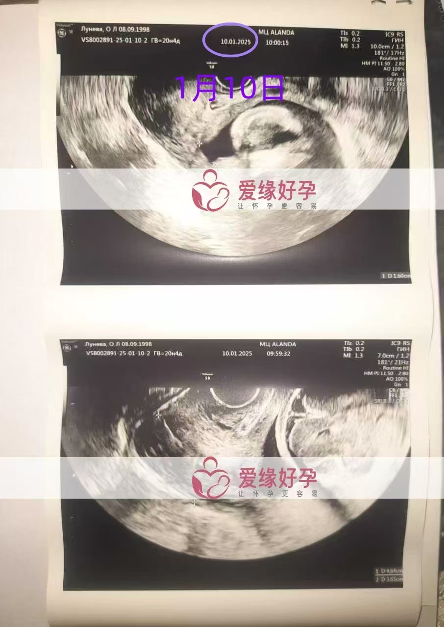 哈萨克斯坦代孕代母孕21周产检顺利通过