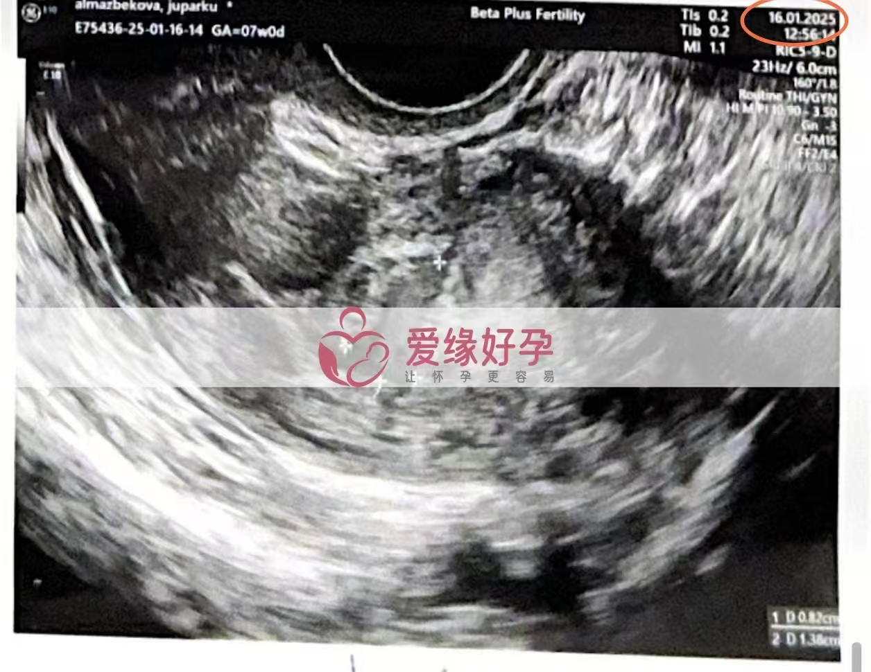 格鲁吉亚代孕代母第一次B超顺利通过