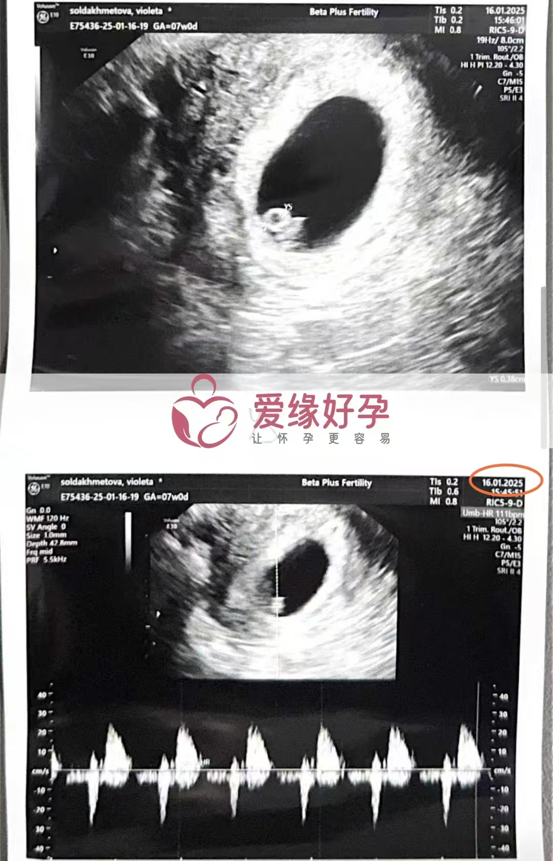 格鲁吉亚代孕代母第一次B超顺利通过