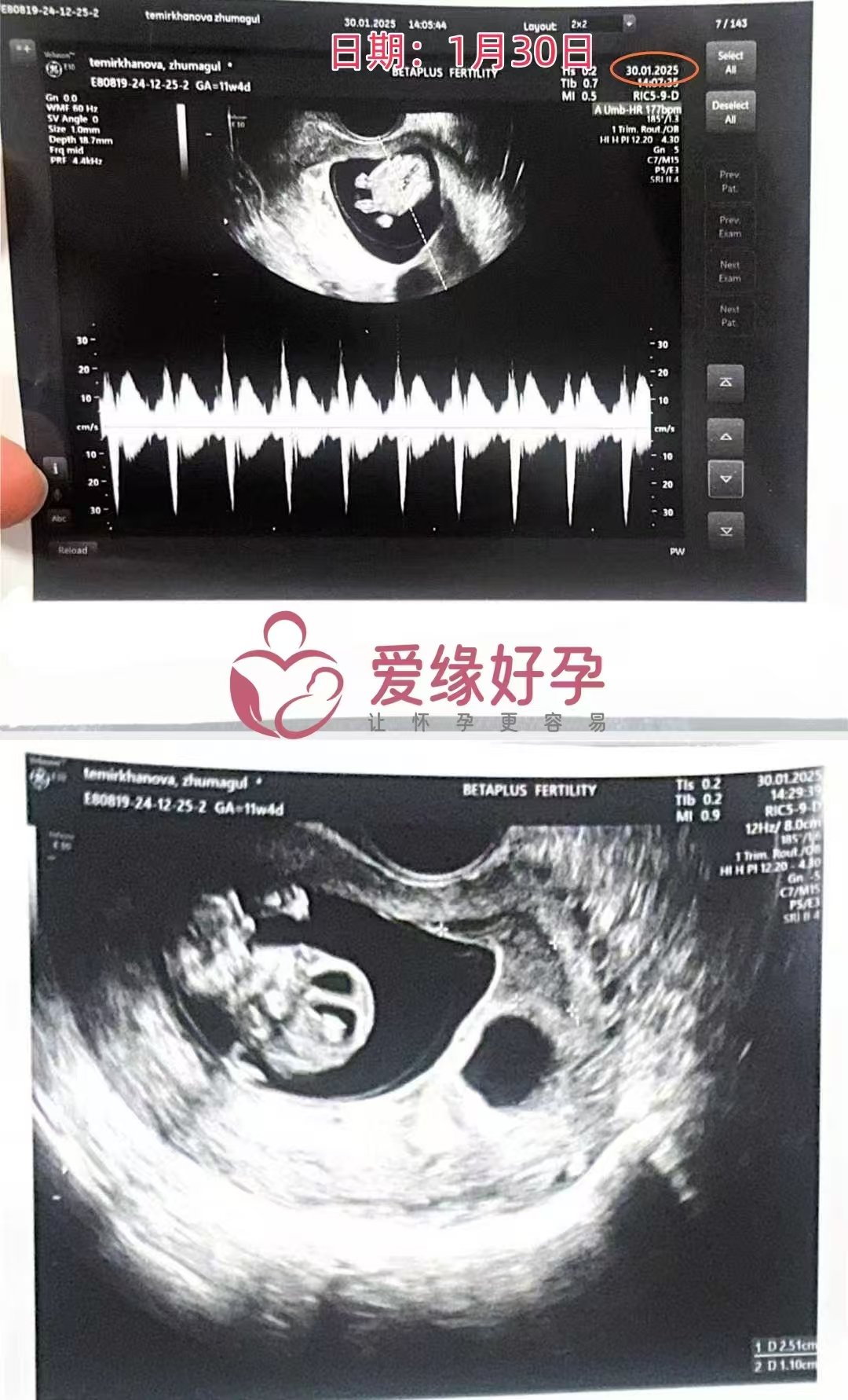 格鲁吉亚代孕代孕代母开启幸福新旅程