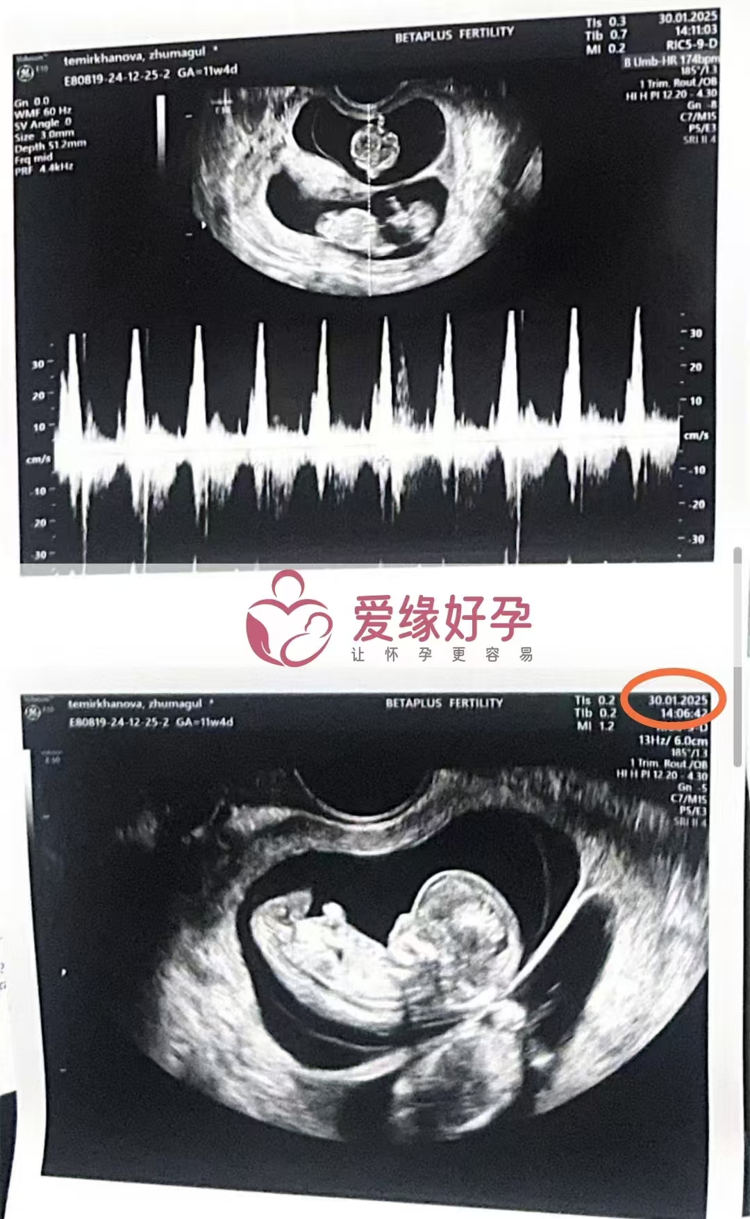 格鲁吉亚代孕代孕代母开启幸福新旅程