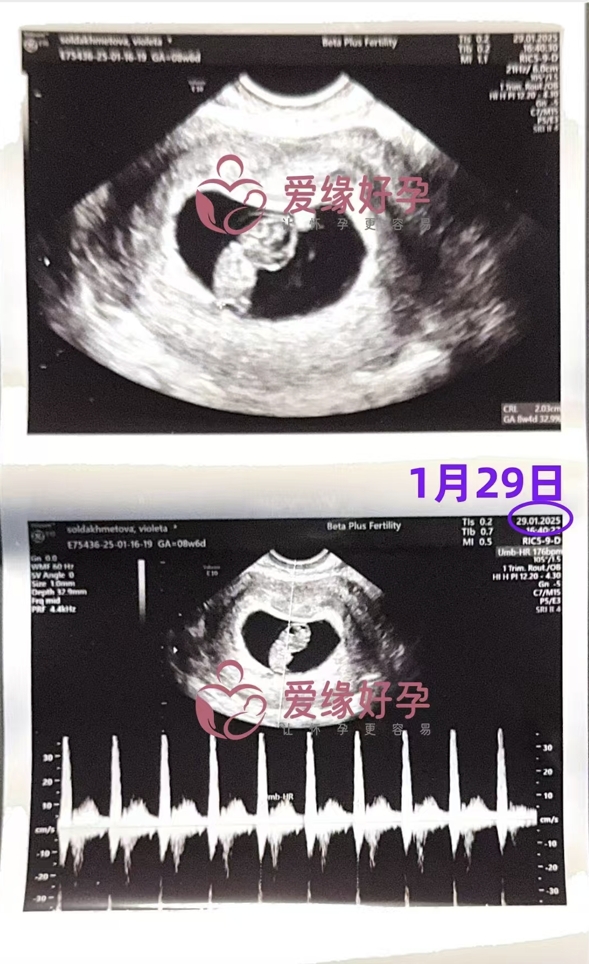 格鲁吉亚代孕代孕代母8周孕检顺利通过
