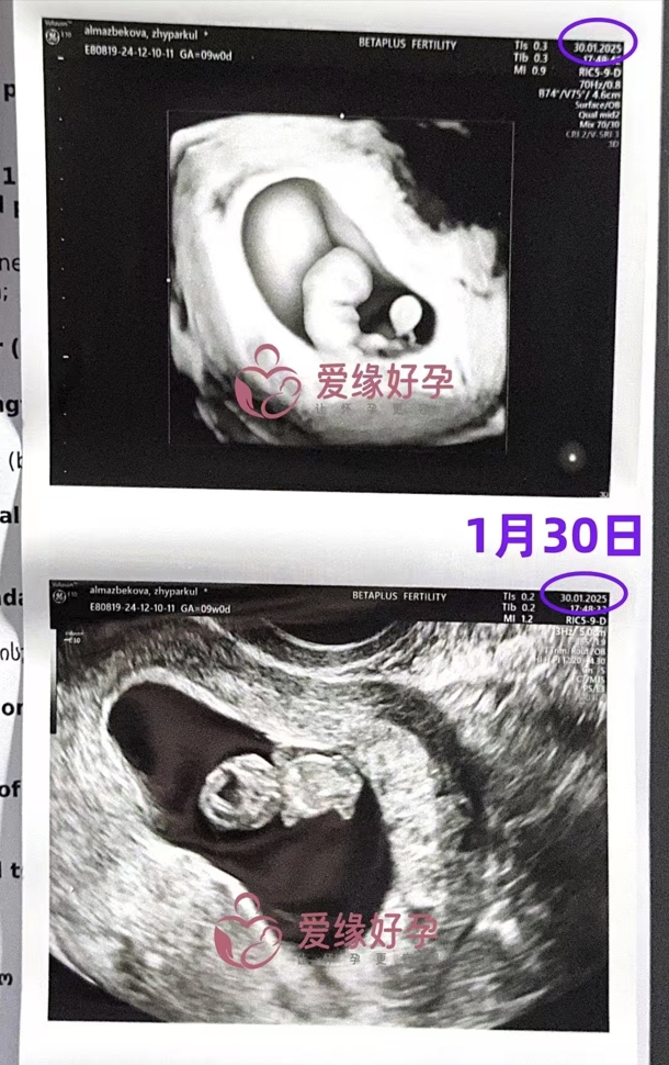 格鲁吉亚代孕代孕代母9周产检顺利，新生命迈出第一步