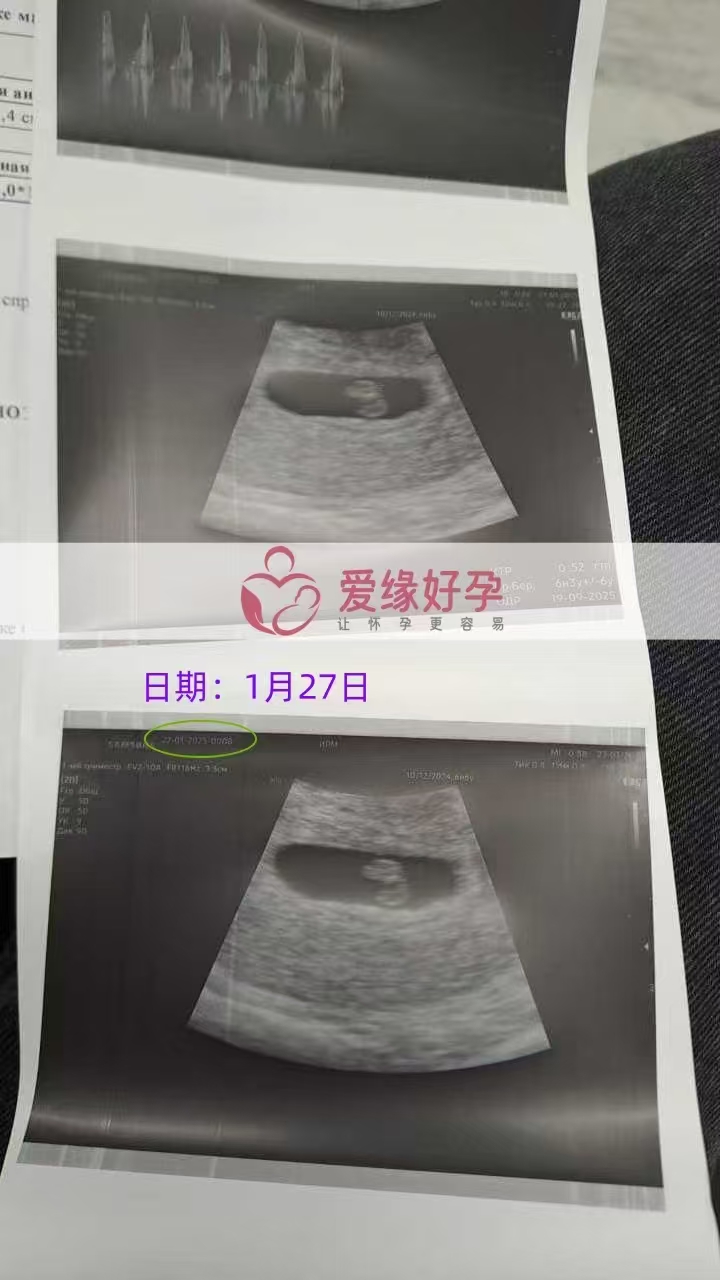 格鲁吉亚代孕代孕代母6周产检顺利通过