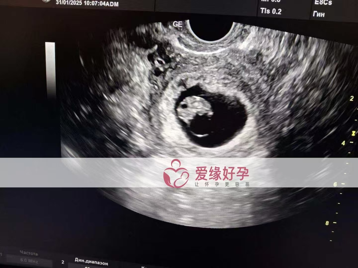 乌克兰代孕代孕代母8周产检顺利通过