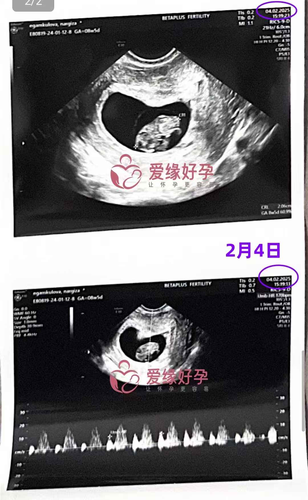 格鲁吉亚代孕代孕代母8周产检顺利通过