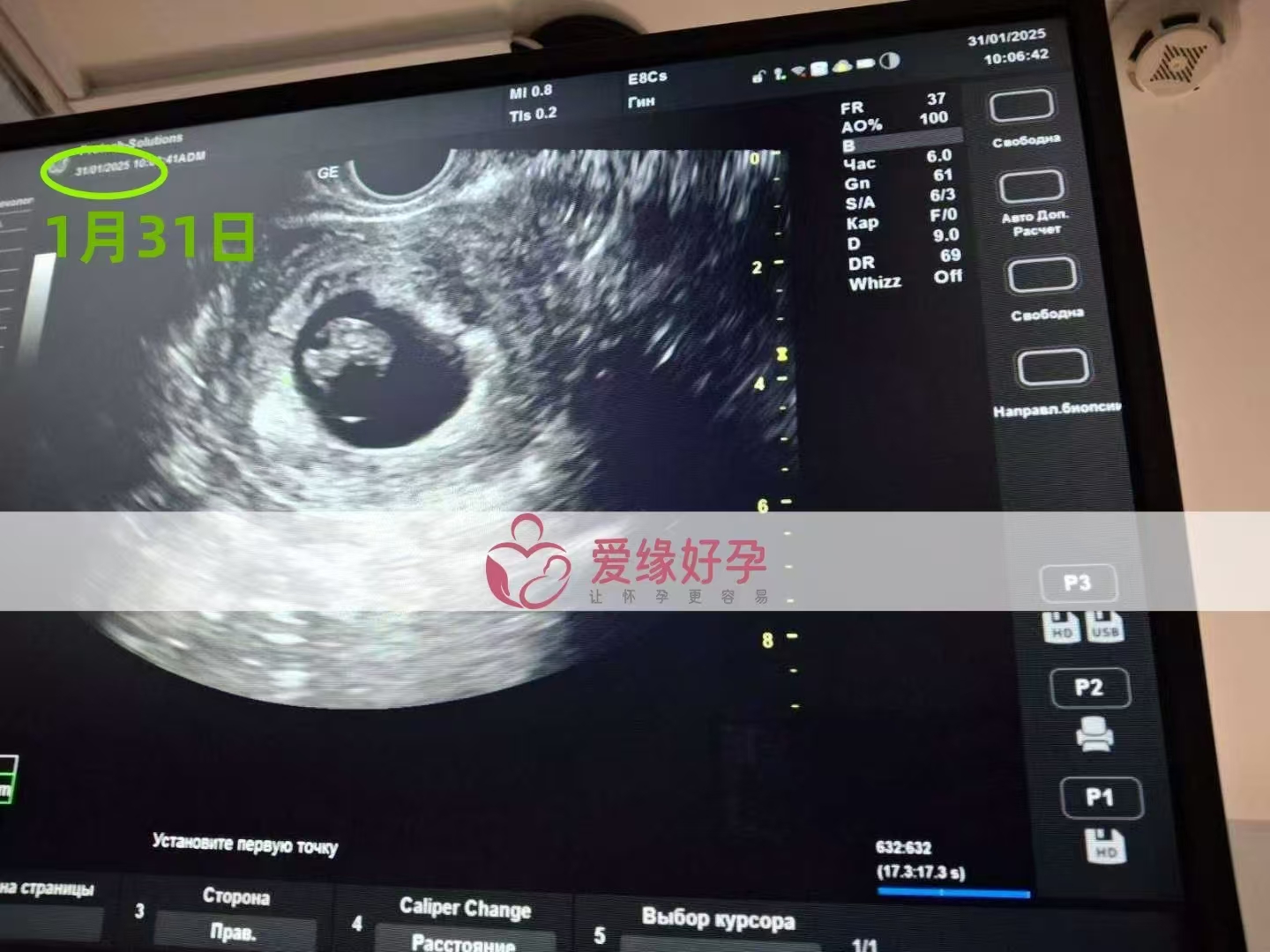 乌克兰代孕代孕代母8周产检顺利通过