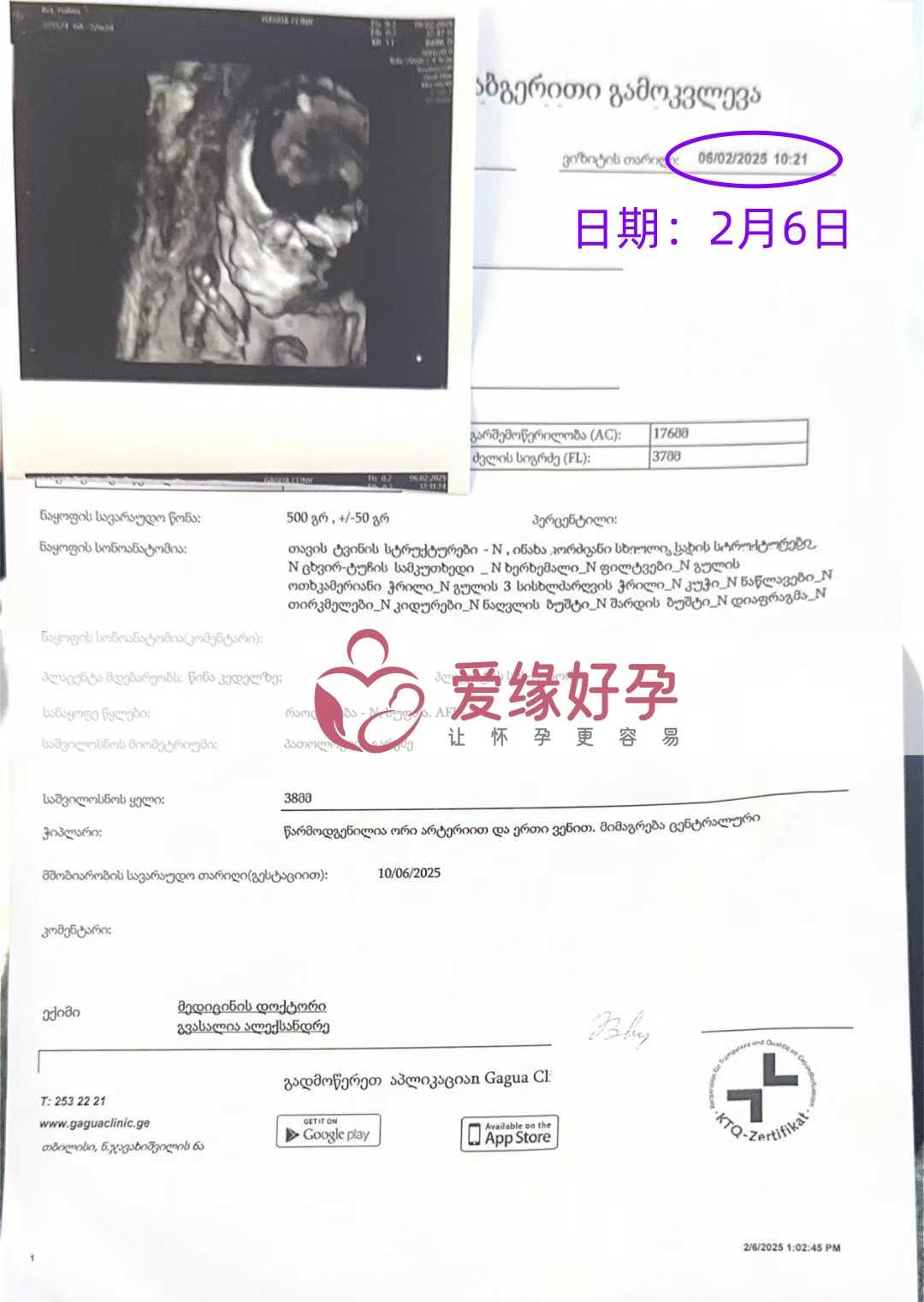 格鲁吉亚代孕代孕代母22周产检进展良好