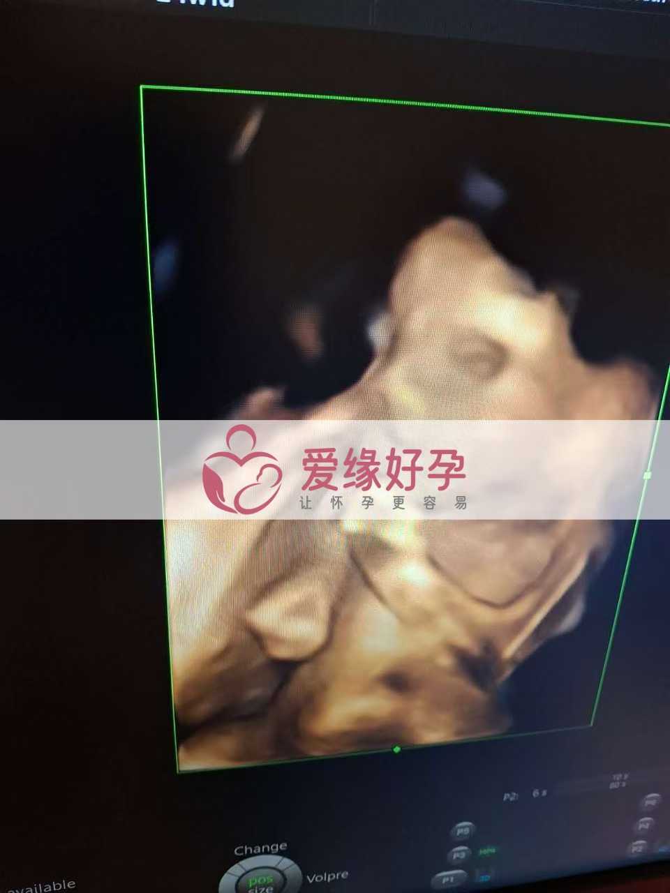 乌克兰代孕代孕代母24周产检顺利通过