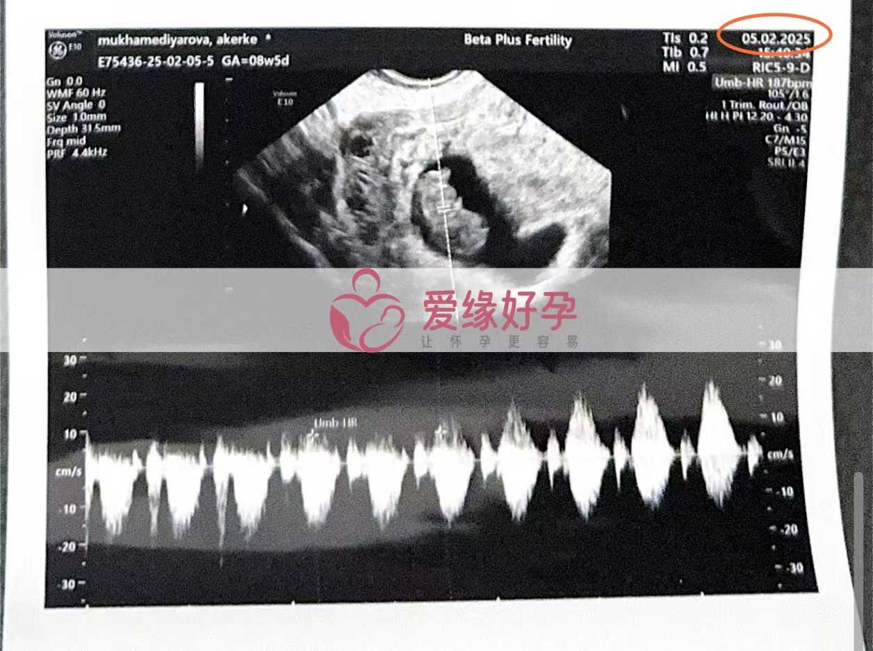 格鲁吉亚代孕代孕代母8周产检进展顺利