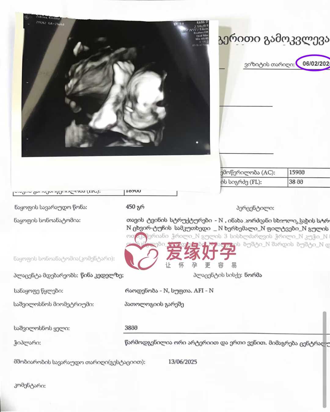 格鲁吉亚代孕代孕代母21周产检进展顺利