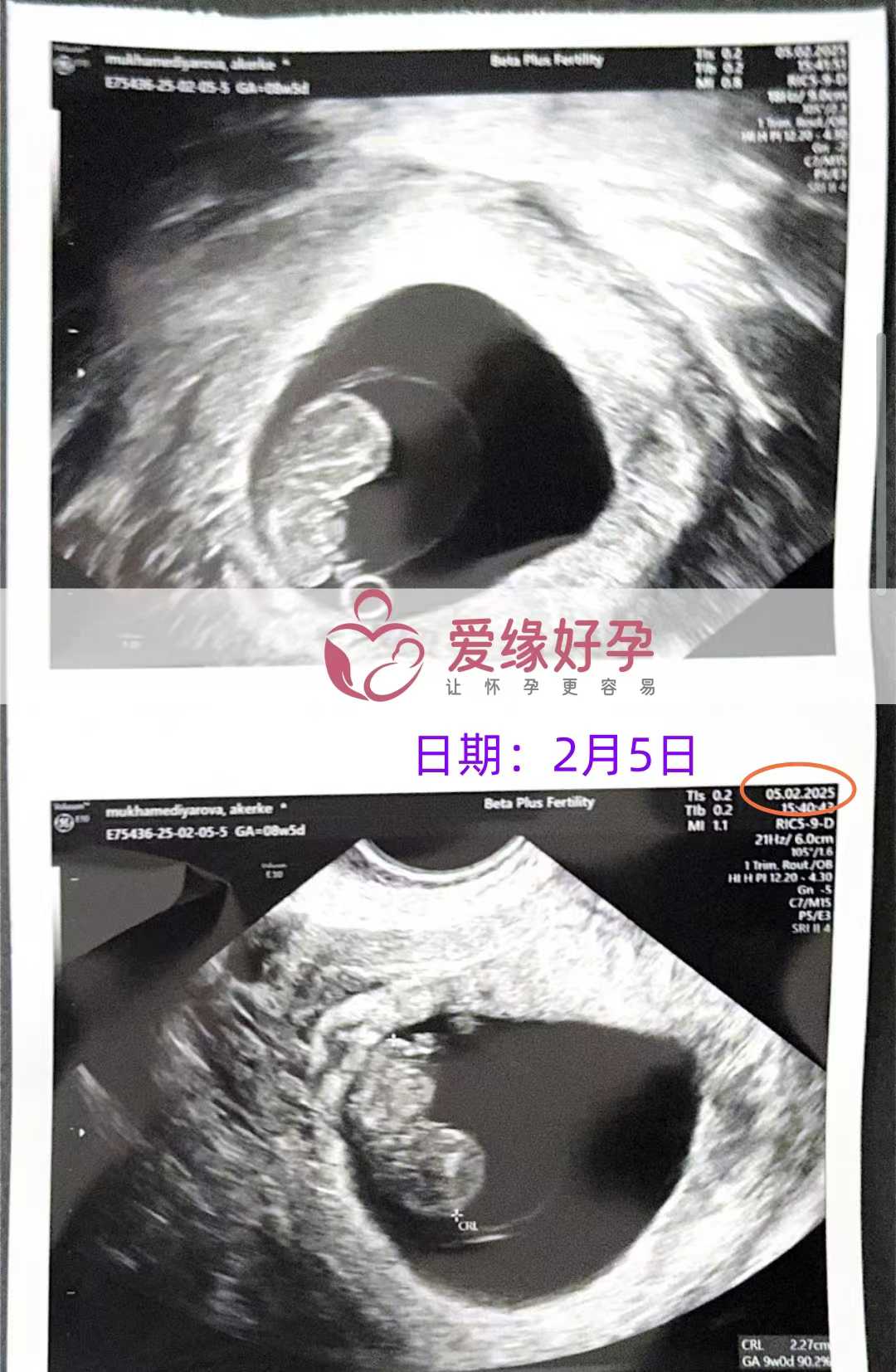 格鲁吉亚代孕代孕代母8周产检进展顺利