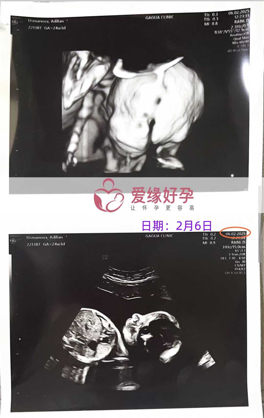 格鲁吉亚代孕代孕代母25周产检顺利通过