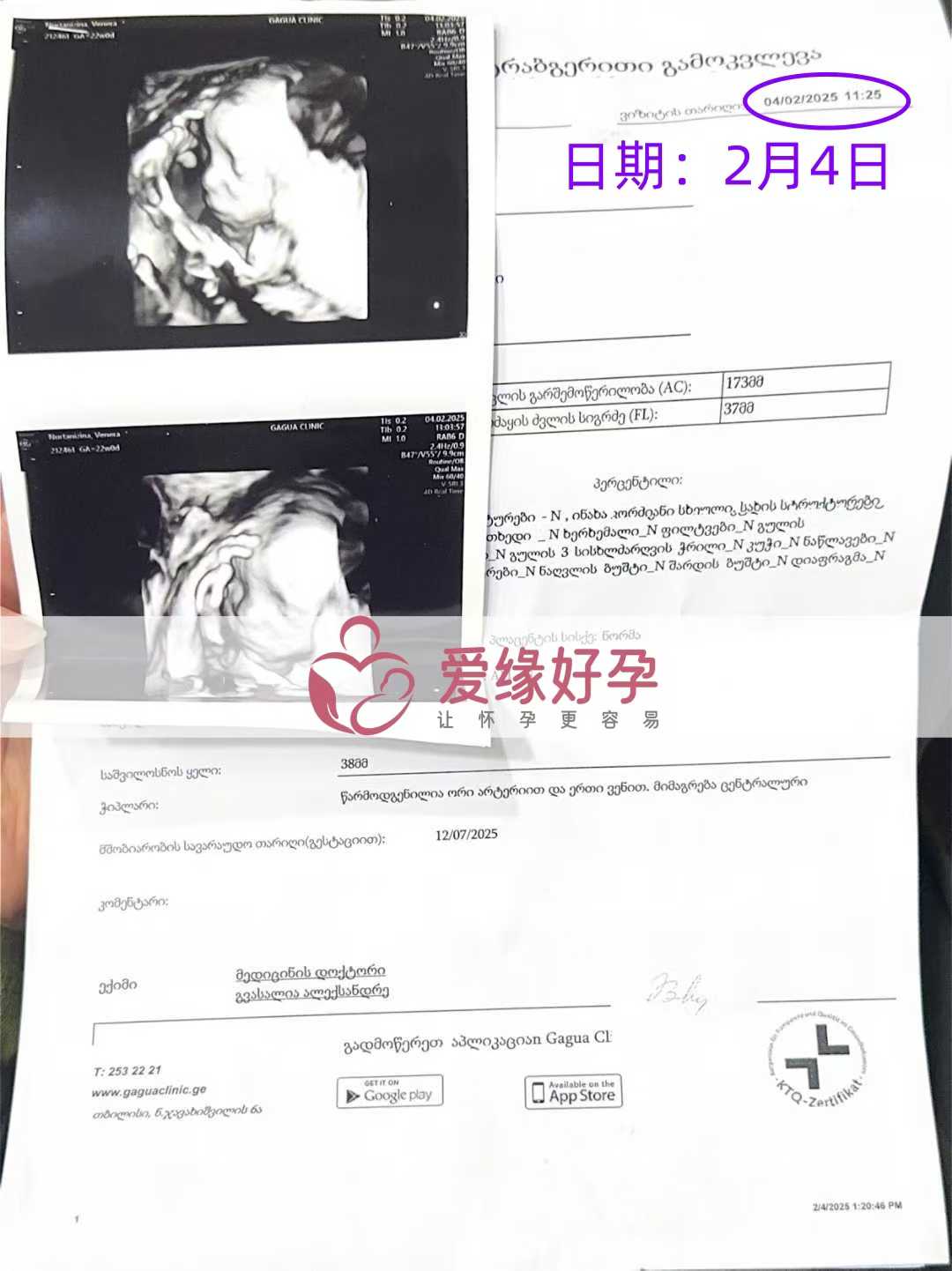 格鲁吉亚代孕代孕代母顺利通过21周产检
