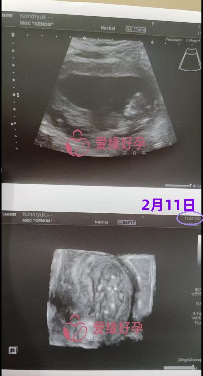 格鲁吉亚代孕代孕代母11周产检顺利通过