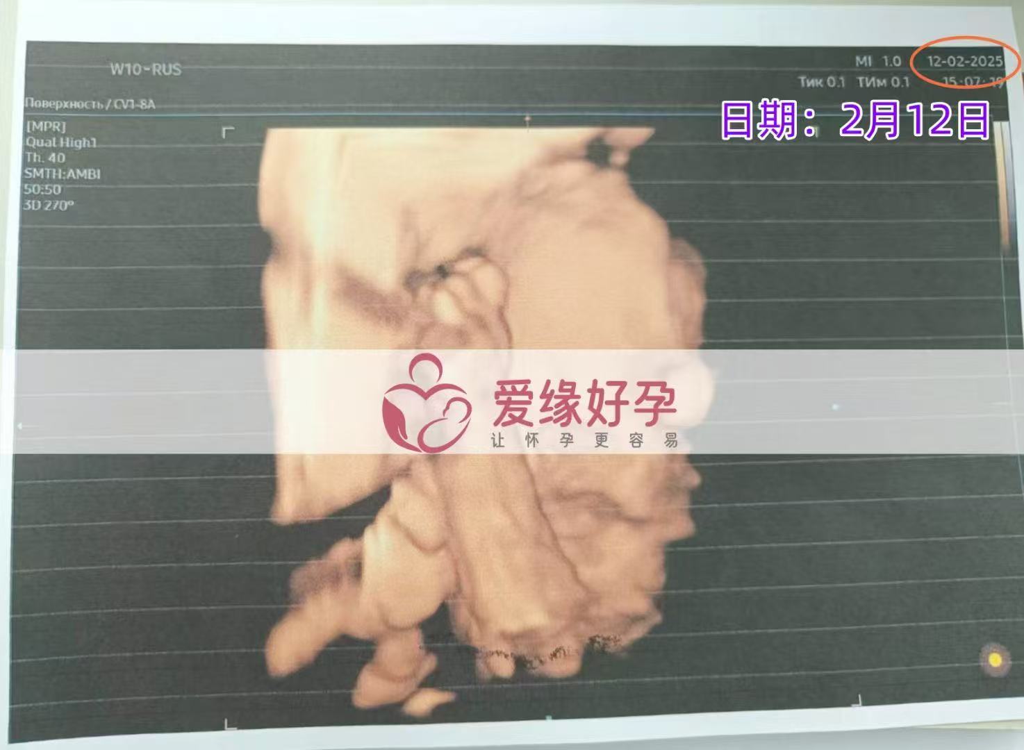 哈萨克斯坦代孕代孕代母29周产检顺利通过