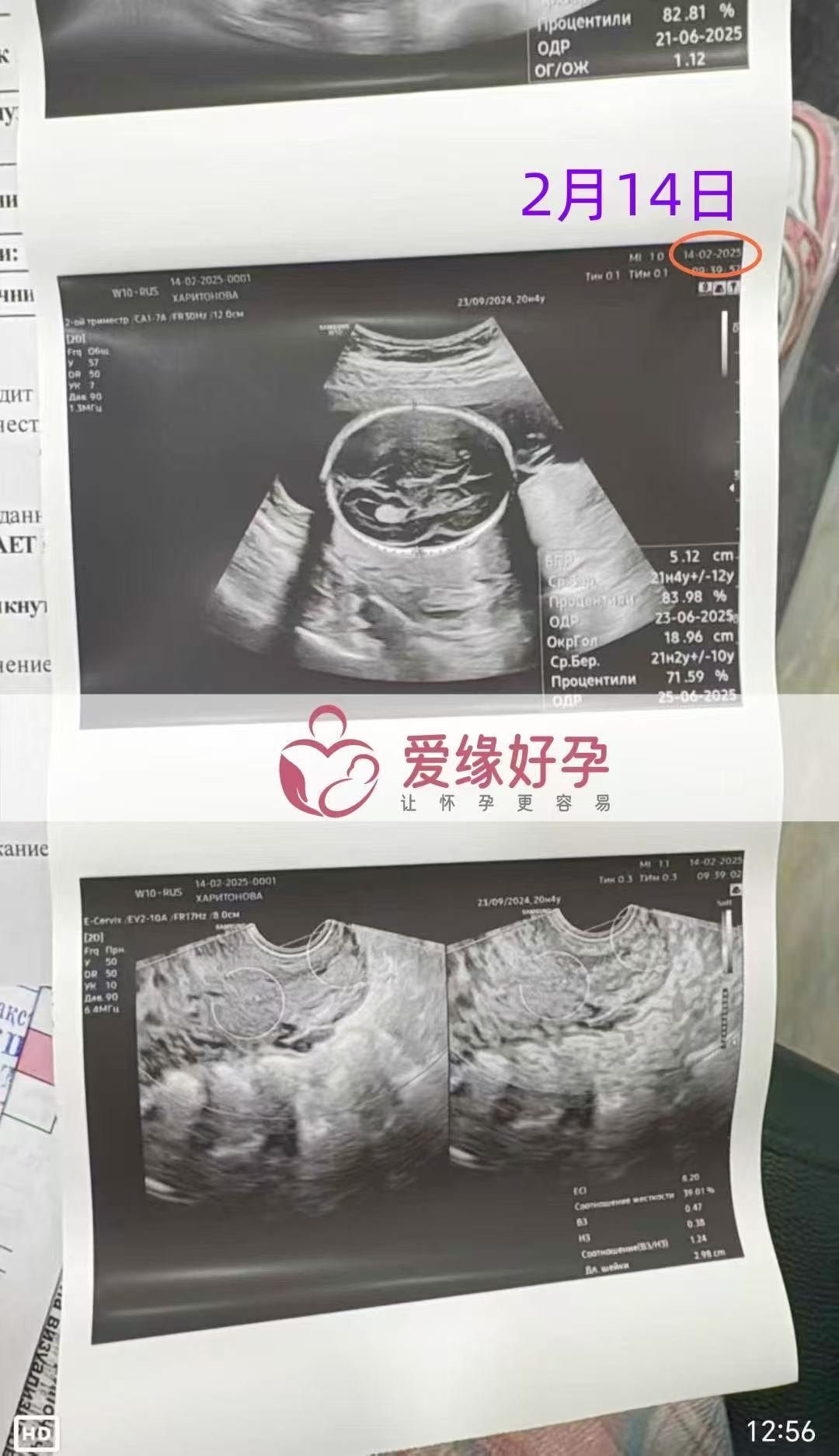 哈萨克斯坦代孕代孕代母20周产检顺利通过