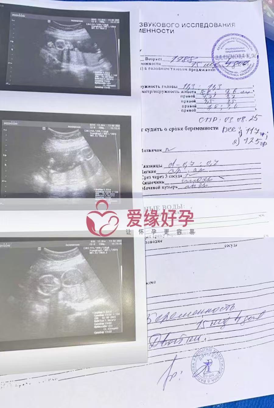 格鲁吉亚代孕代孕代母顺利步入稳定期